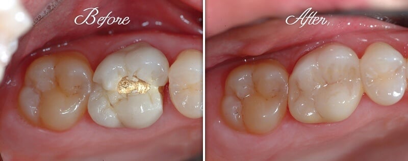 Crown Before and After