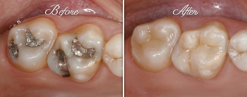 Inlay Before and After